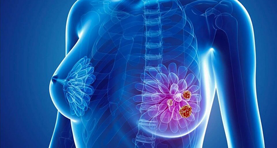 Breast Cancer