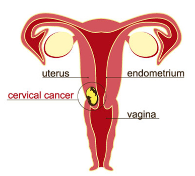 Cervical Cancer