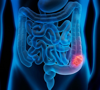 Colon Cancer