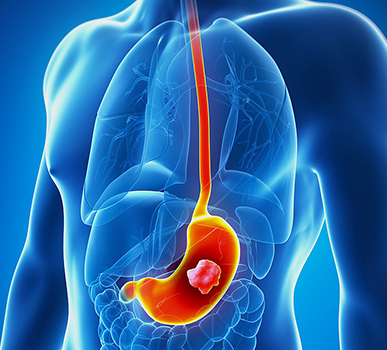 Gastric Cancer