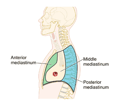 Mediastinal Tumor