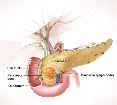 Neuroendocrine Tumor