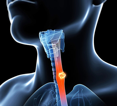 Oesophageal Cancer