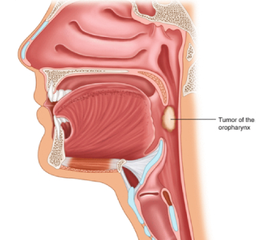 Oropharynx Cancer