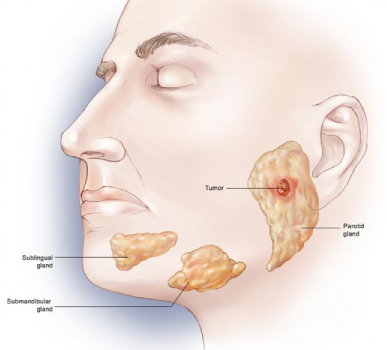 Parotid Tumor