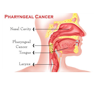 Pharyngeal Cancer
