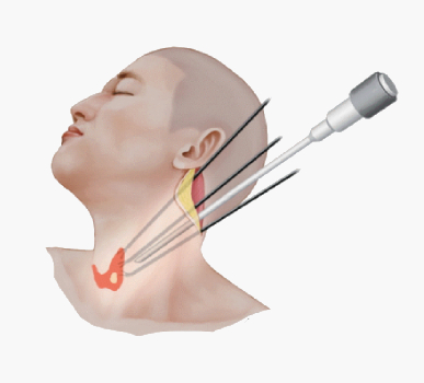 Remote Access Surgery