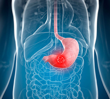 Stomach Cancer