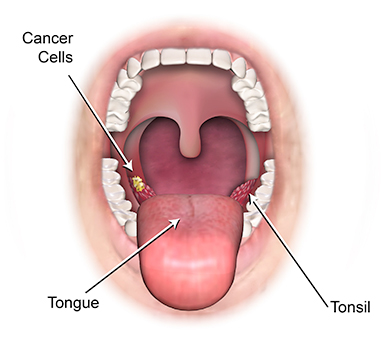 Tongue Cancer